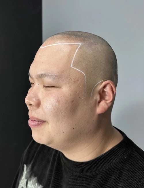 두피문신 시술 전 2