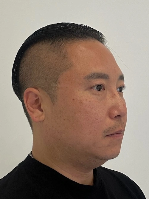 두피문신 시술 전 6