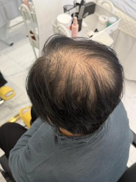 여성 두피문신 시술 전 3